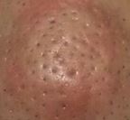 角栓の詰まりによる黒ずみ